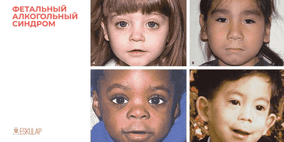 Исследование показывает, что расстройство алкогольного спектра у плода дорого обходится