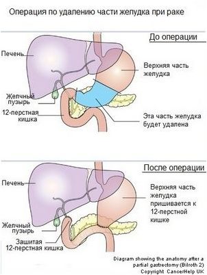 мочевого пузыря